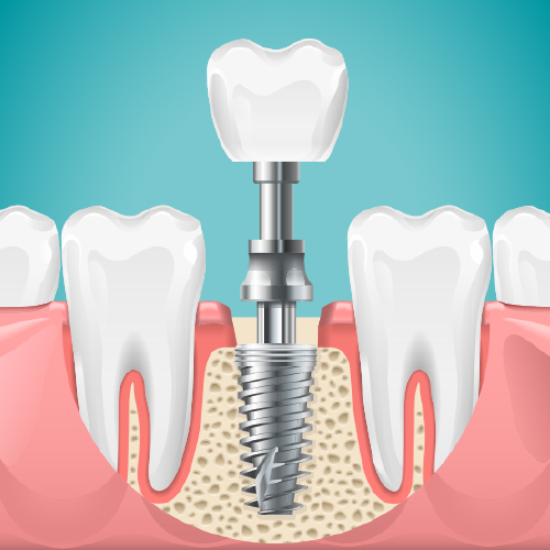 A Beautiful Smile Dentistry Dental Implants