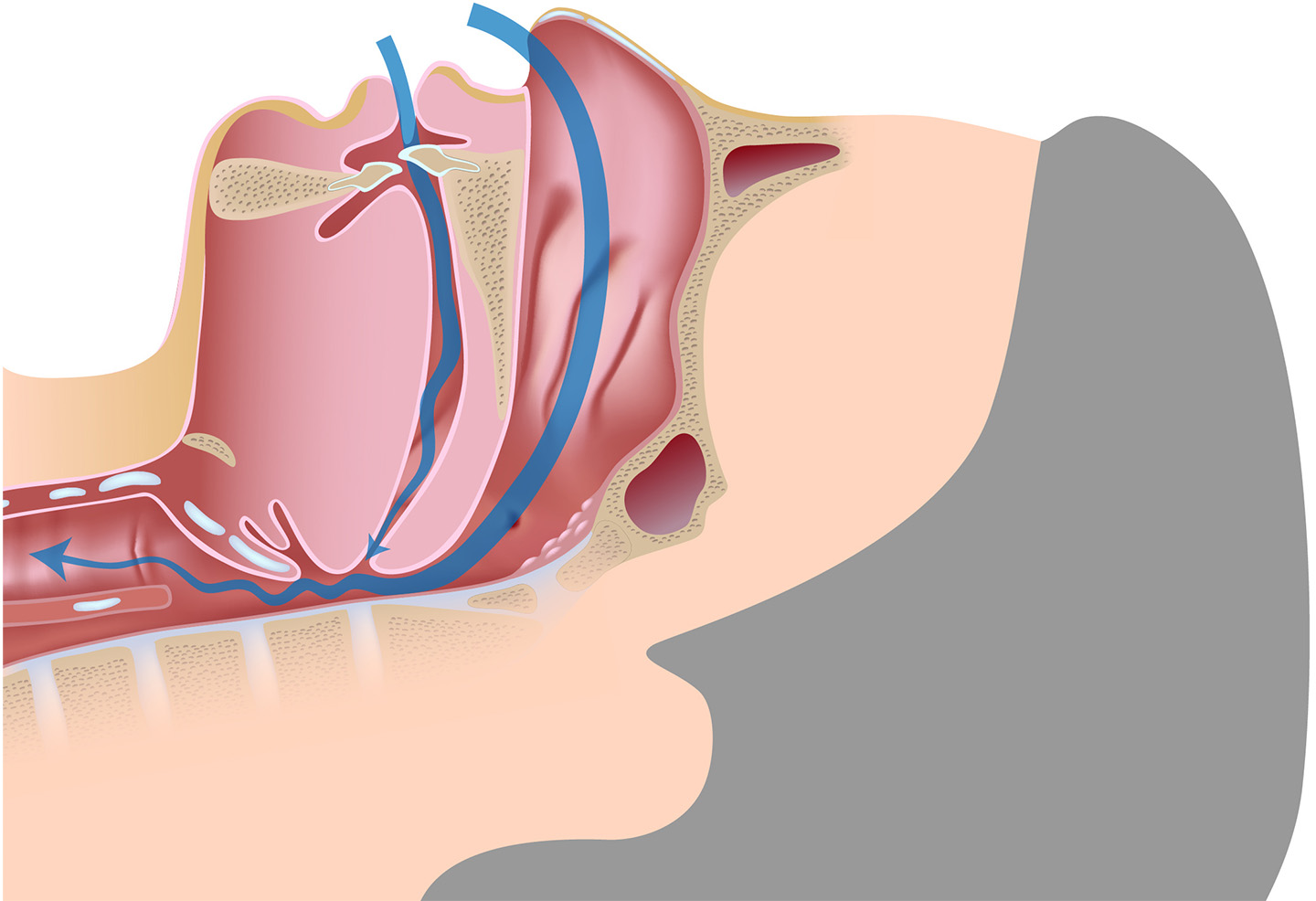 Drawing of a person snoring as his airway is being constricted by his tongue.